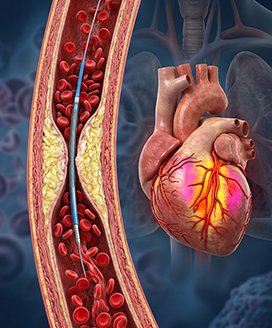 Interventional Cardiology