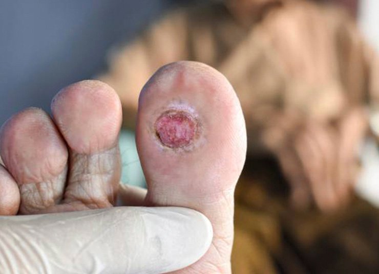 5 Essential Care Tips For Foot Ulcers